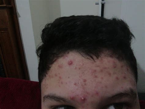Any Advice To Get Rid Of This Big Nodule Cant Afford Dermatologist