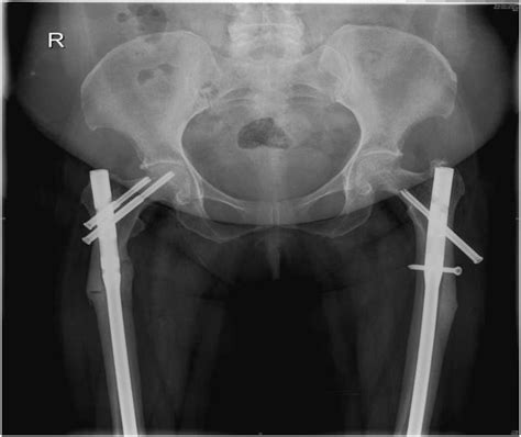 Bilateral Atypical Femur Fracture Following Intramedullary Nailing And