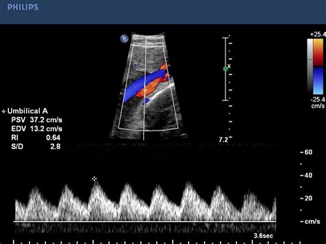 Umbilical Artery S D Ratio Chart