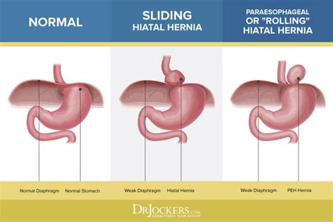 The Different Stages Of Liver Surgery