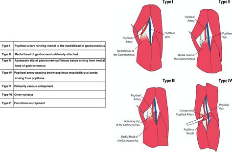 Popliteal Entrapment Syndrome Journal Of Vascular Surgery