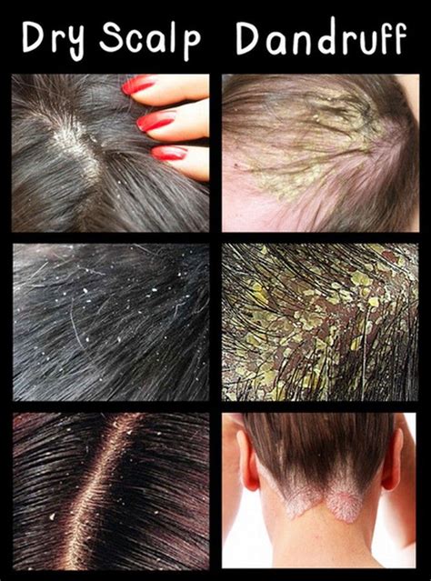 It Can Be Caused By Severe Dehydration And Over Shedding Of The Scalp