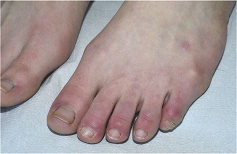 Chronic Acral Lesions “covid Toes” To Add To Long Post Covid 19