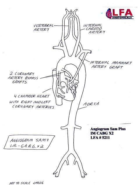 The coronary arteries wrap around the outside of the heart. Angiogram Sam Plus IM CABG X2 with two Coronary Artery ...