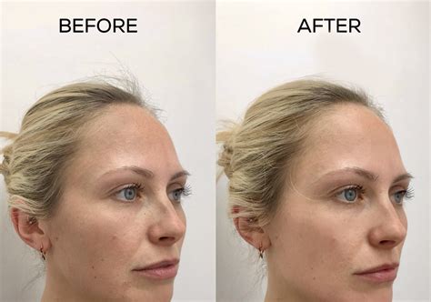 Sun Damaged Treatment London Sun Spots Removal Clinic Harley Street