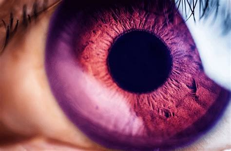 Purple Eyes Disease
