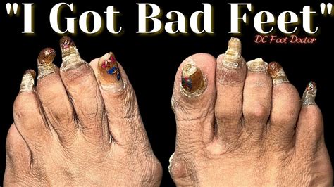 I Got Bad Feet Part Trimming Fungal Toenails Youtube