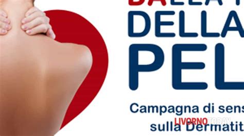 Livorno Visite Gratuite Per La Dermatite Atopica Dell Adulto