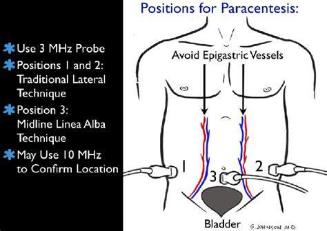 Paracentesis Procedure