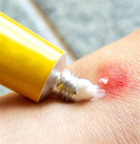 Best Bug Bite Relief Products Of 2022 Antibacterial Antibacterial Topical Mosquito Bite Skin