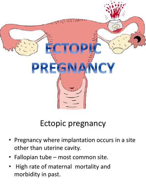 Ectopic Pregnancy Womens Health Clinical Medicine Free 30 Day