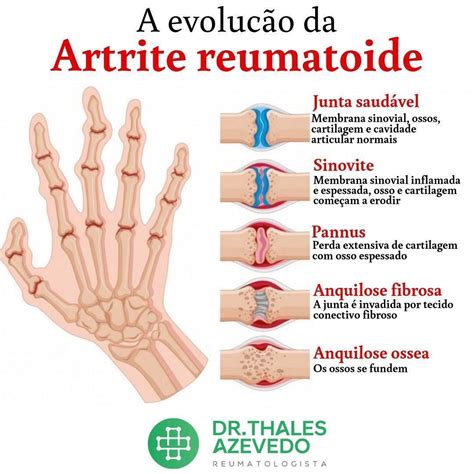 Artrite reumatoide causa sintomas diagnóstico e tratamento