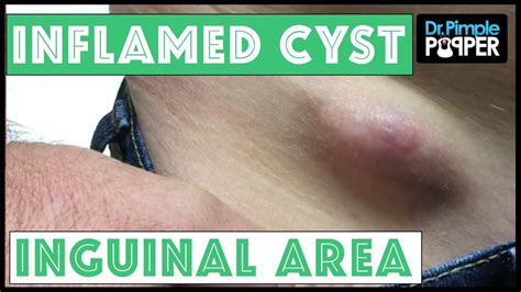 Inflamed Egg Shaped Cyst Removed Right Inguinal Area Epidermoid Cyst Cysts Pimple Popping