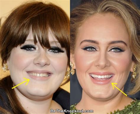 Adele Plastic Surgery Comparison Photos