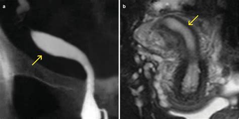 Congenital Uterine Anomalies Radiology Key