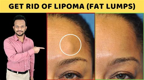 Do This Once A Day And Get Rid Of Lipoma 3 Natural Ways To Treat Fat