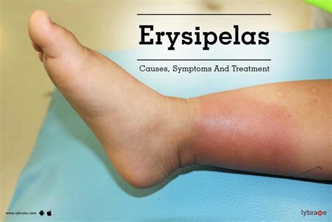 Erysipelas Causes Symptoms And Treatment By Dr Vinod Chavan Lybrate