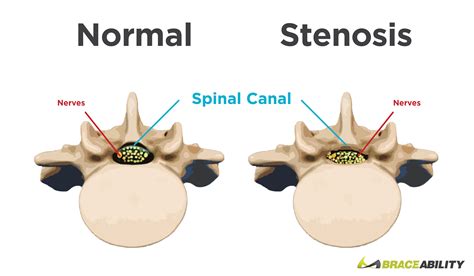 Spinal Stenosis Narrowing Of The Spine Cervical Spinal Stenosis