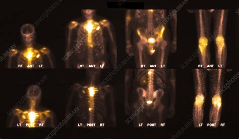 Bone Scan Showing Multiple Metastases Stock Image C0271192