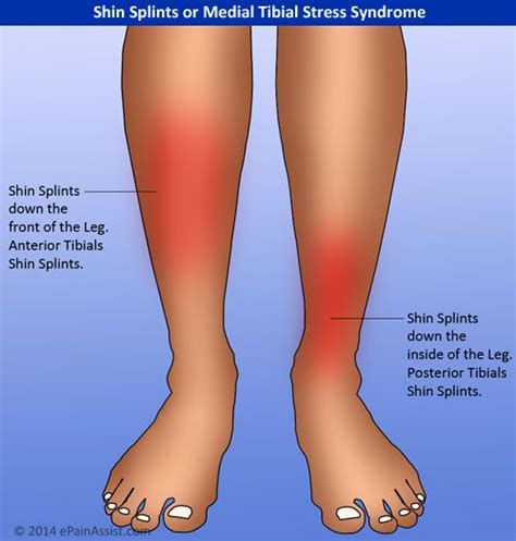 How To Recognize Shin Splints Shin Splints Shin Splints Treatment