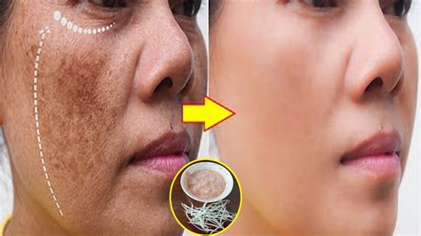 Any Melasma Freckles And Age Spots On Face Will Disappear Completely