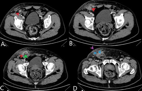 Emergency Imaging Of A Rare Cause Of Inguinal Swelling Amyands Hernia