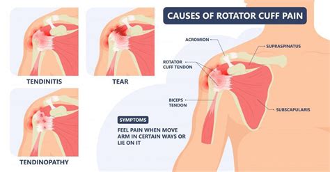 Are You Suffering With These Symptoms Of A Rotator Cuff Tear Dr