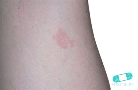 Strawberry Marks Hemangioma