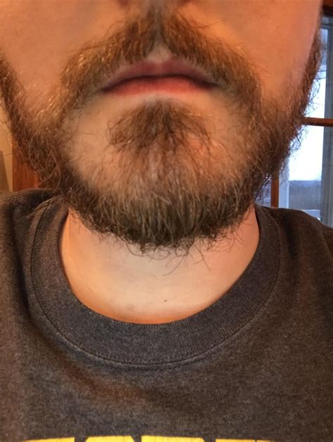 31 Years Old Beard And Mustache Connect On Left Side But Not The Right