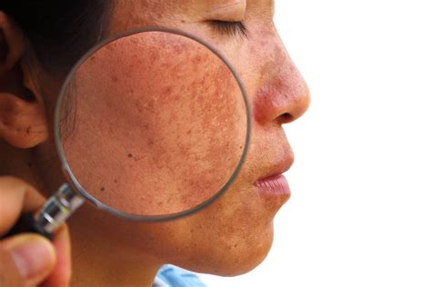 The Melasma Pcos Connection Victorian Dermal Group