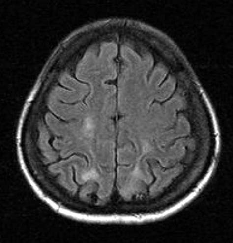 Multiple Embolic Phenomenon In The Brain Associated With Parenteral