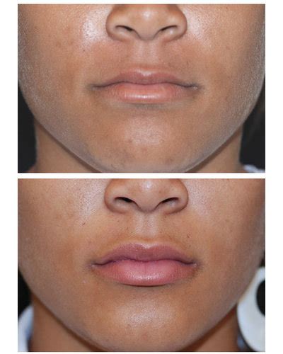 Dermal Fillers Before And After Photos Raleigh Nc