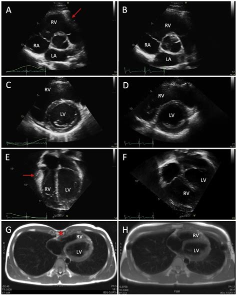 Transthoracic Echocardiographic And Mri Images Demonstrating Anatomical