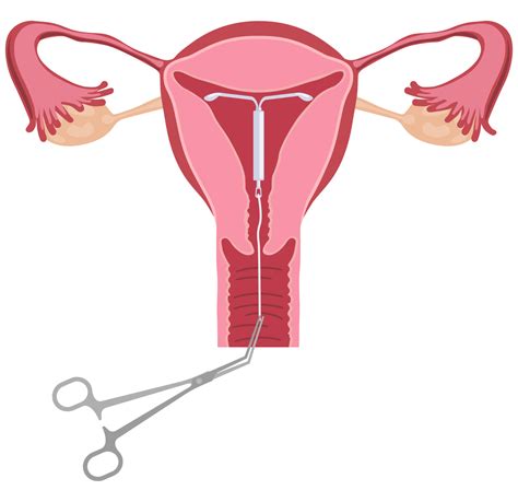 Mirena Removal What To Expect During After IUD Removal