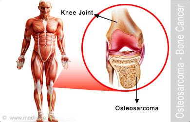 While there are treatments and methods for achieving remission or even curing cancer in dogs, each. Osteosarcoma - Predisposing Factors Symptoms Signs ...
