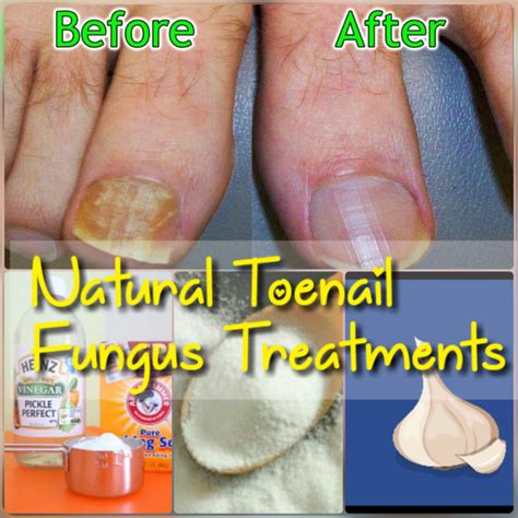 Nail Fungus Vs Nail Psoriasis Nails Salon