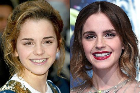 Celebrity Teeth Before And After Teeth Whitening Makeovers Pictures 2017 Glamour Uk