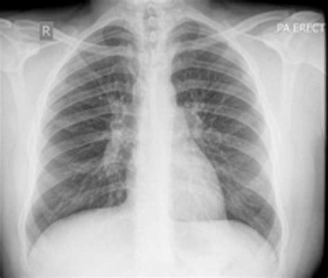 Subcutaneous Emphysema In Acute Asthma A Cause For Concern