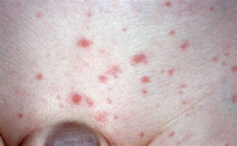 Rocky mountain spotted fever can be difficult to diagnose because the early signs and symptoms are similar to those caused by many other diseases. Rocky Mountain spotted fever causes, symptoms, rash and ...