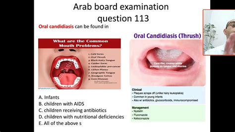 Mcq 113 What Are The Differences Between Oral Thrush And Hairy Leucoplakia Candidiasis Fungal