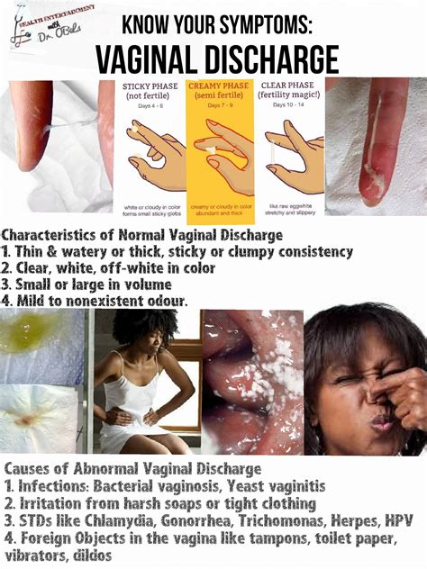 Chlamydia Vaginal Discharge