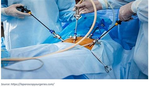 All You Need To Know About Laparoscopic Myomectomy Dr Shweta Shah