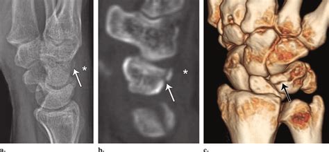 Triquetral fracture. Lateral radiograph (a), sagittal ...