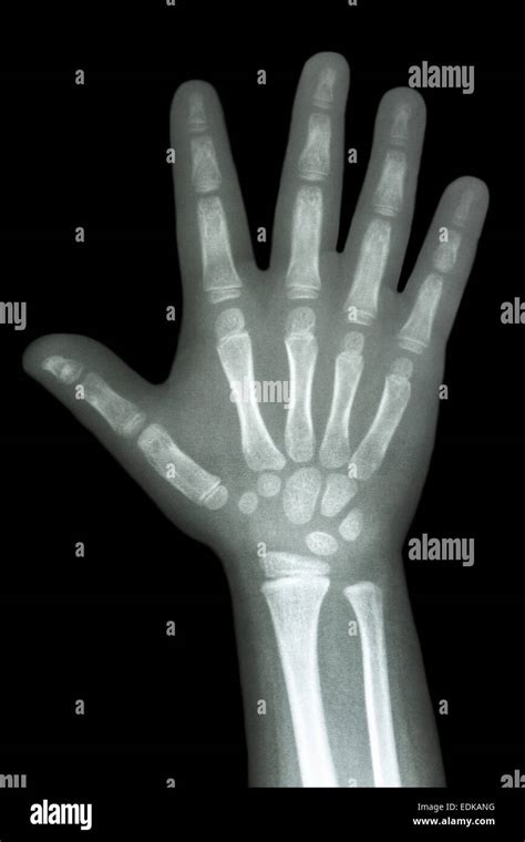 Approach To Hand X Rays · Rheumtutor 342