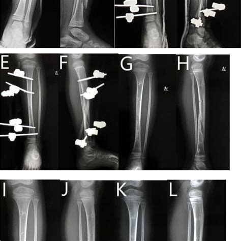 Five Year Old Girl With Gustilo Anderson Grade Iiia Tibial Fracture