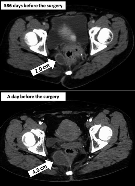 Axial Ct Duplication Cyst On Right With Wide Communication With Rectum Download Scientific