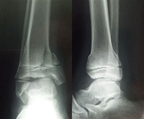 Paediatric Salter Harris Type Iv Injury Of Distal Tibia With Talus