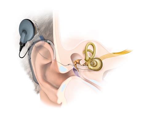 Cochlear Implant And Hearing Implant Images Pictures MED EL