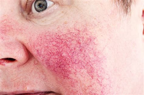 Portrait Of Unhappy Elderly Woman Suffering Skin Disease Rosacea With