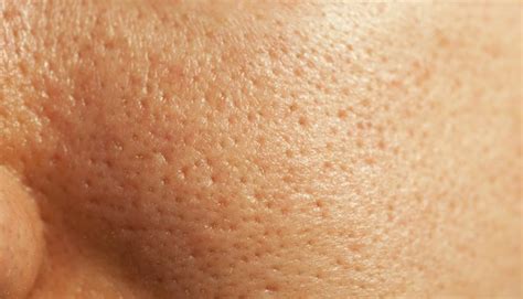 What Are Open Pores Types Causes What Difference Between Open Pore
